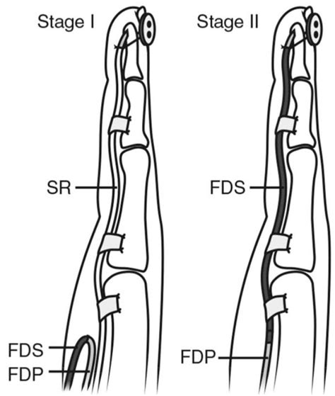 fdp medical abbreviation hand